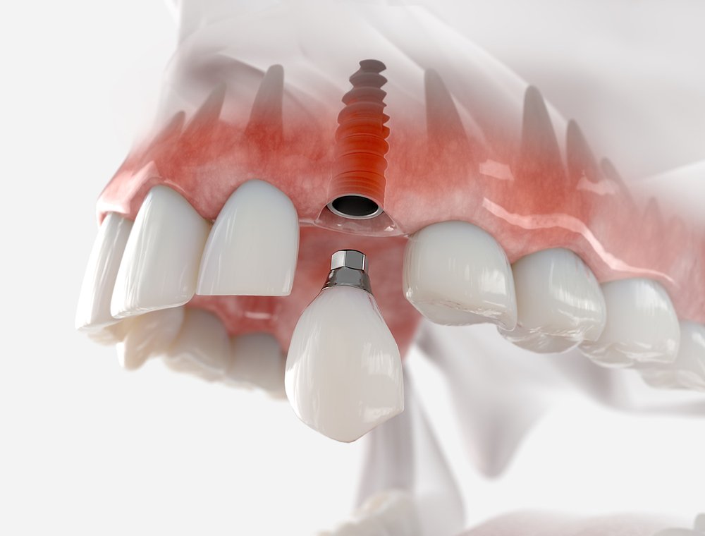 Top Dental Clinics for Dental Implants and Veneers