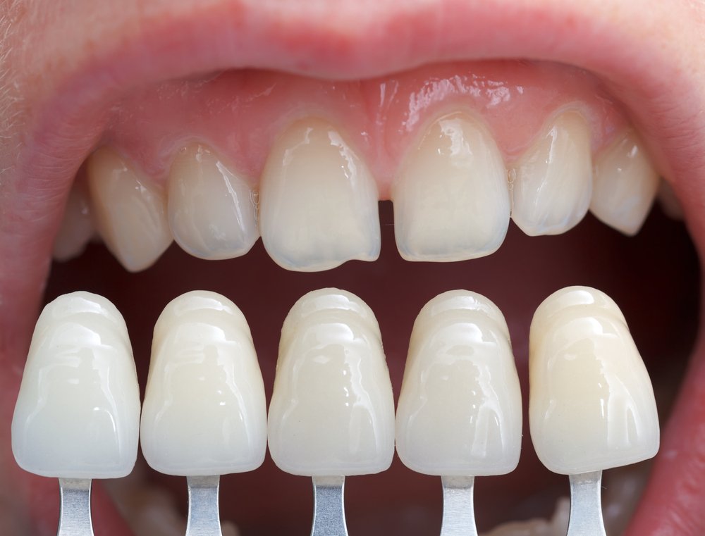 Understanding Veneers What are They and How Do They Work