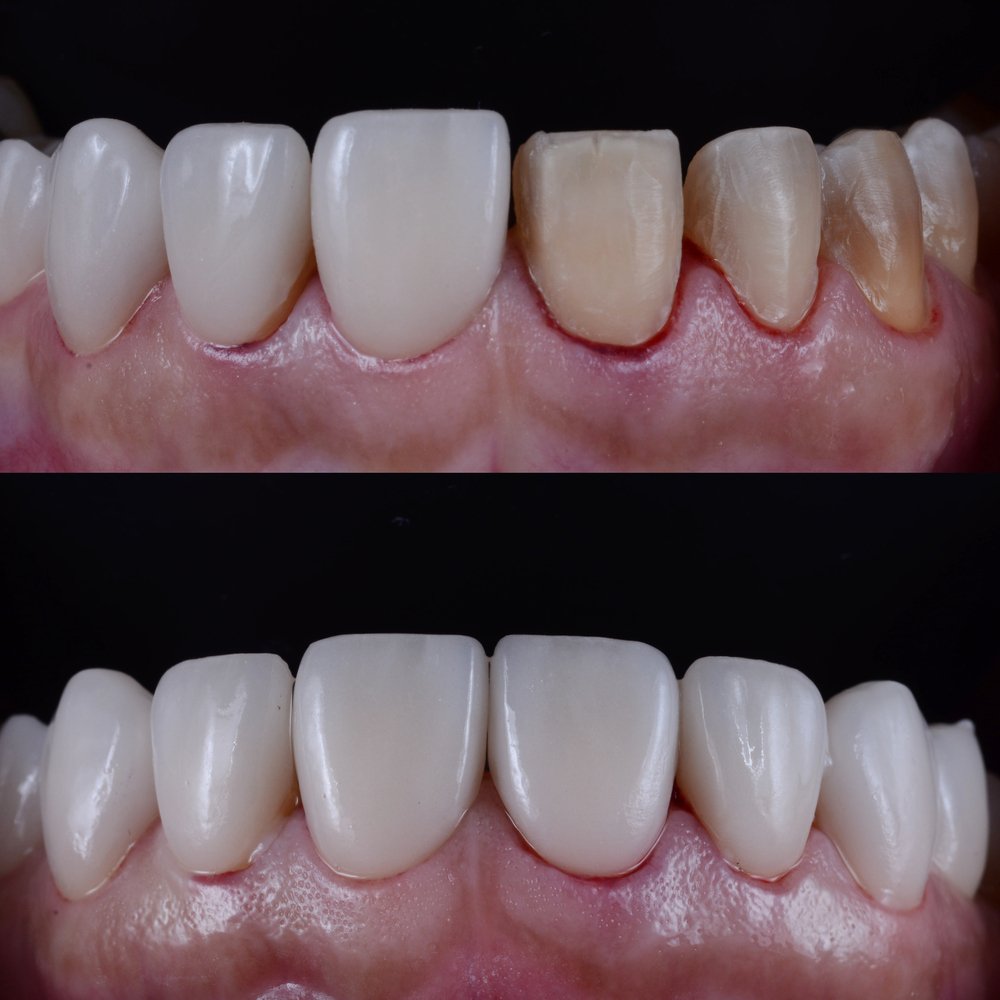 What are Veneers and How Do They Work