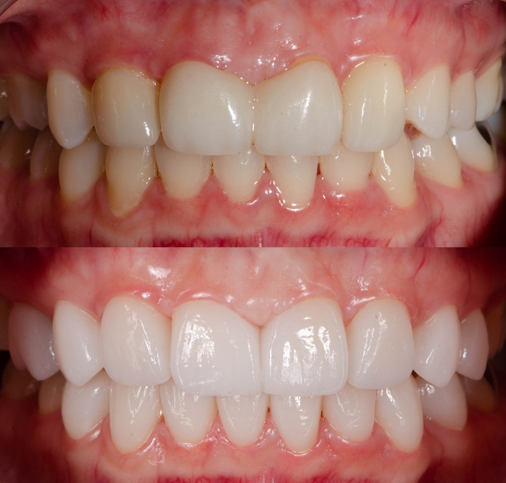 Why Choose Poland for Your Veneers
