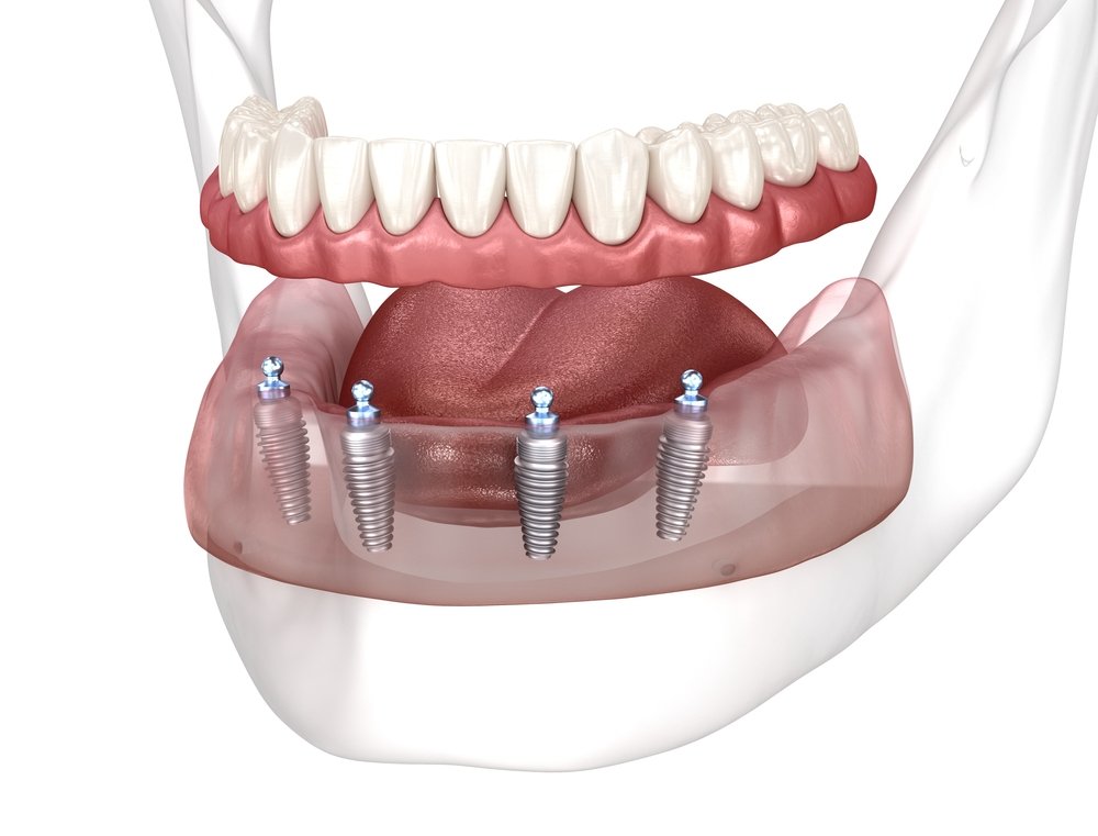 All on 4 Dental Implants Consultation at Miami Perfect Smile