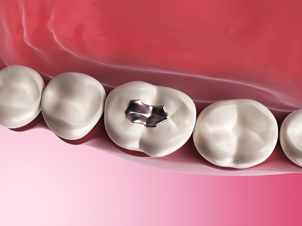 Consultation white fillings at Miami Perfect Smile - Book Now!