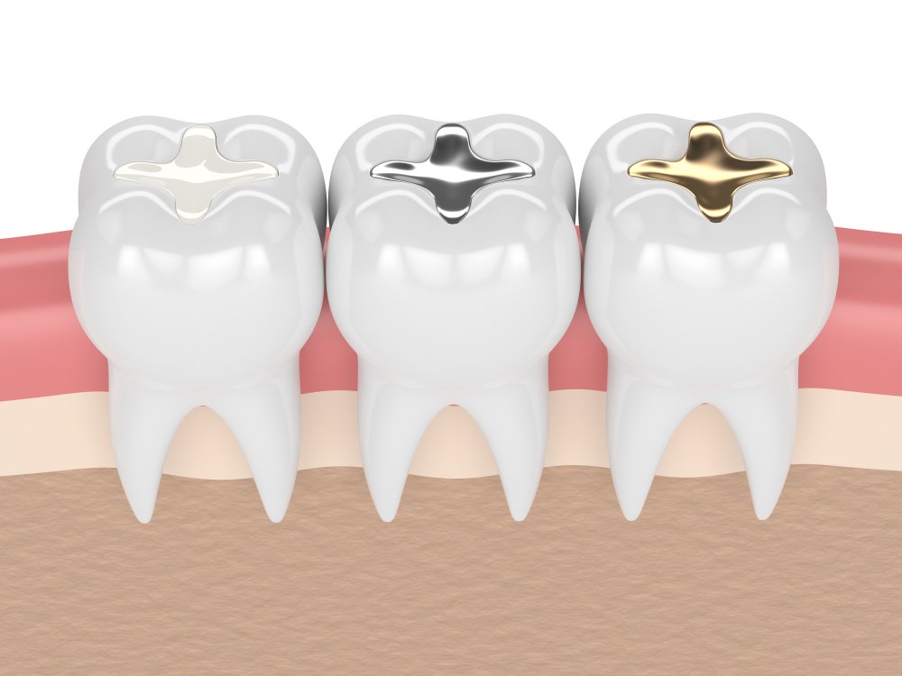Cost for White Fillings in Miami Aesthetic and Affordable Dental Restorations