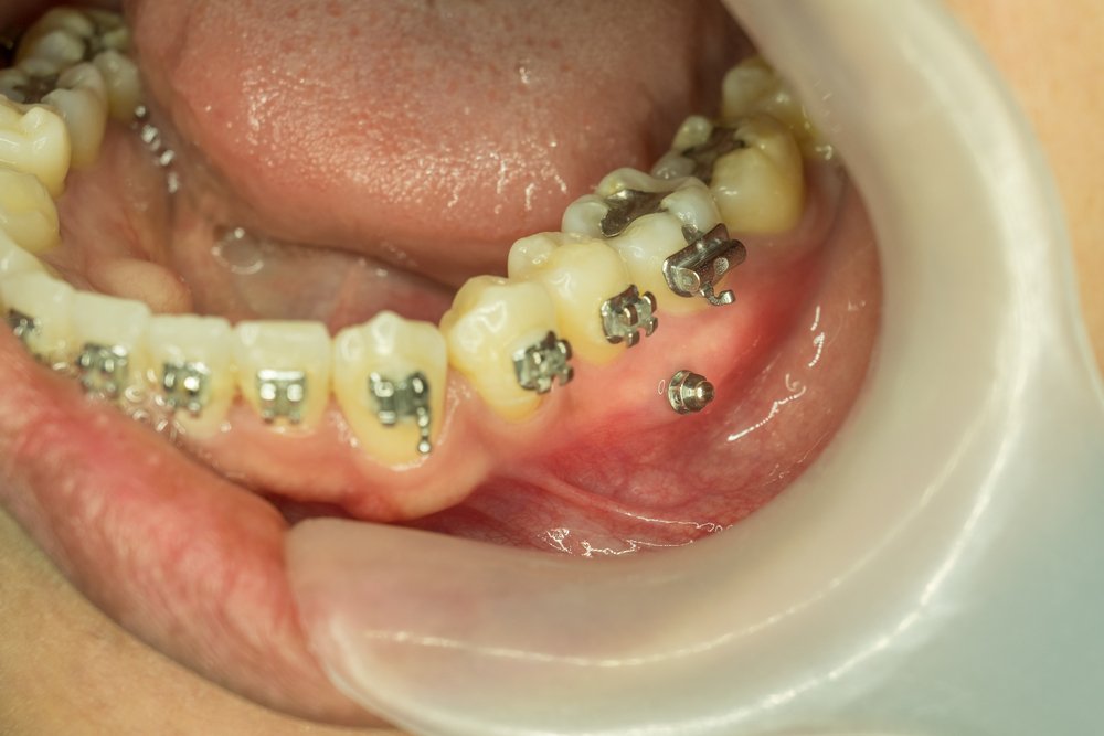 Cost of Mini Dental Implants in Miami