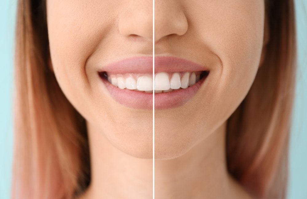 Dental Insurance Cover Teeth Contouring