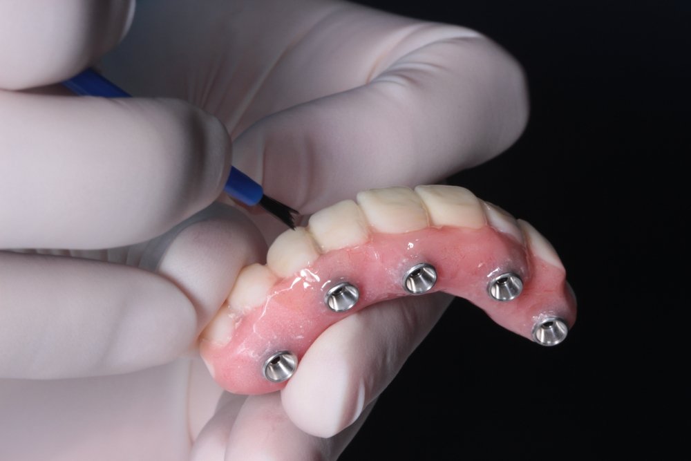 Does Dental Insurance Cover All on 4 Dental Implants