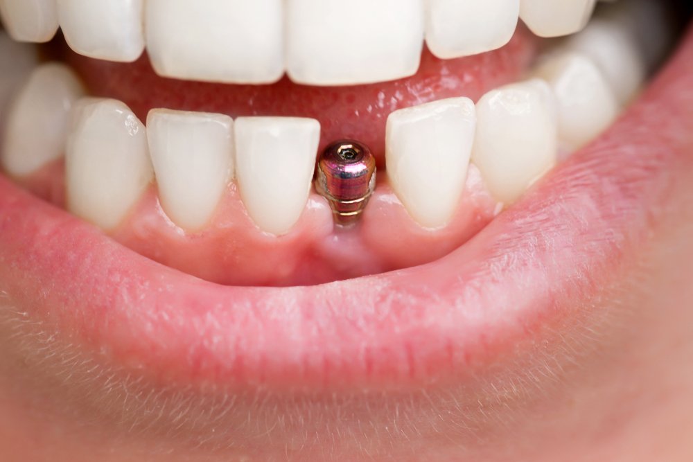 Front Tooth Implant Cost Investing in Your Perfect Smile