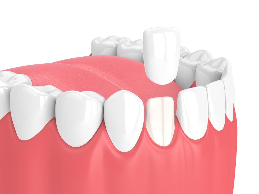 How much does a Composite Resin Veneers cost in Miami