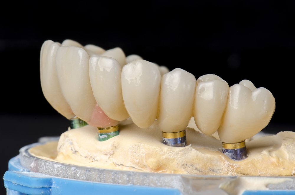 How much does a Full Dental Implants cost in Miami