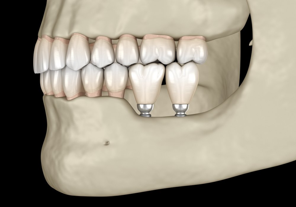Mini Dental Implants in Miami