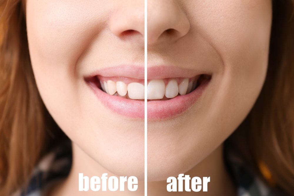 Teeth Contouring Consultation at Miami Perfect Smile Your Path to a Confident Smile