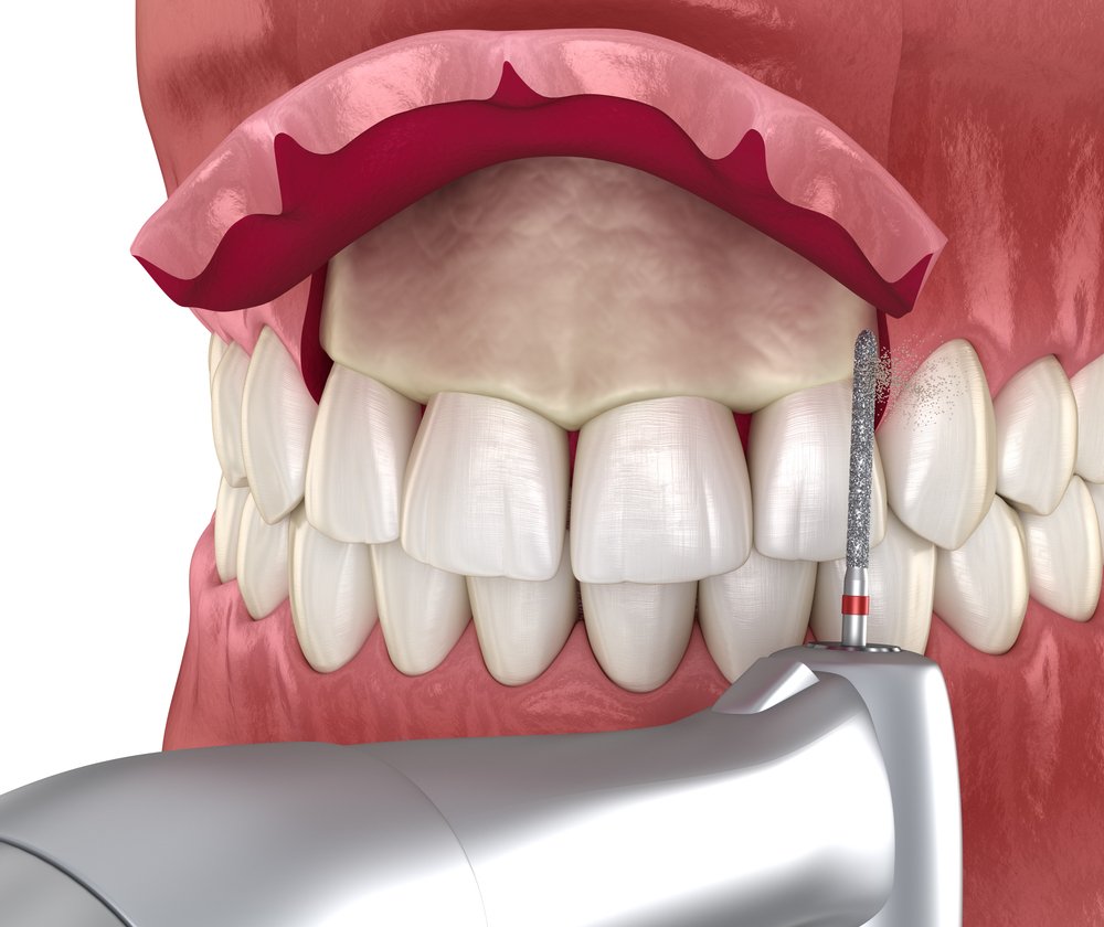 Understanding Dental Insurance Coverage for Gummy Smile Surgery