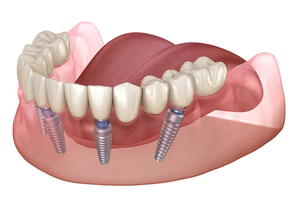 What are All on 4 Dental Implants