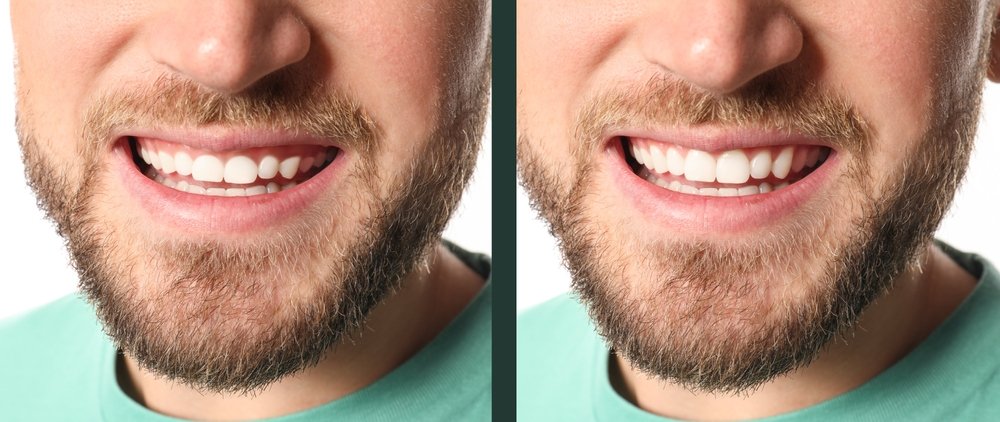 How to Achieve a More Aesthetic Smile: Contouring and Reshaping Teeth